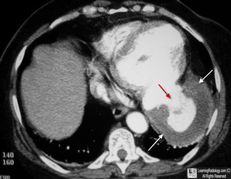 ventricular aneurysm